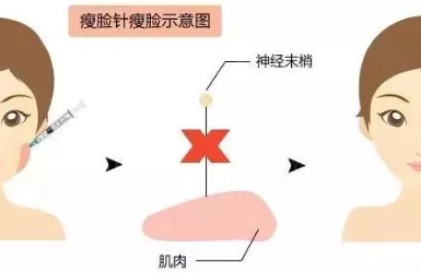 注射瘦脸后咬肌多久会变小