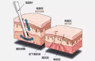 吸脂可以塑形吗？腿部吸脂后凹凸不平怎么办？