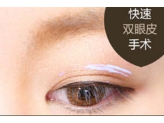 上海双眼皮手术分类有哪几种
