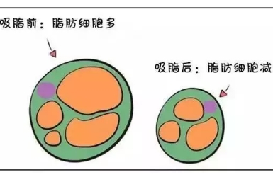 怎么拥有好身材？吸脂科学减肥，水到渠成