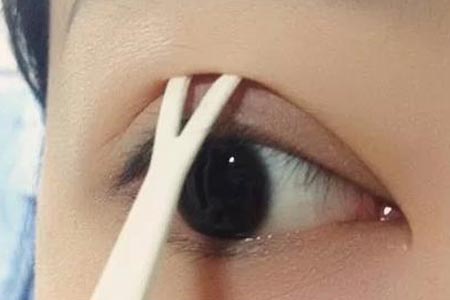 双眼皮整形术后为什么显得很假