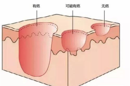 激光去除疤痕真的有吗