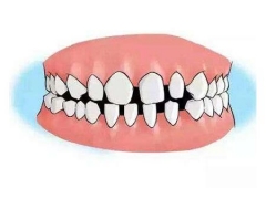 成年人矫正牙齿的方法有哪几种