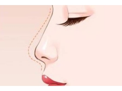 自体软骨隆鼻手术需要注意什么