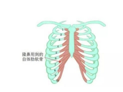 自体软骨隆鼻手术会不会影响身体健康