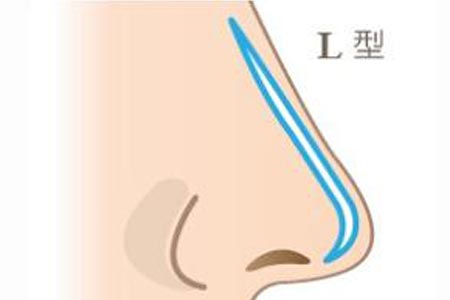 做假体隆鼻整形手术价格贵不贵