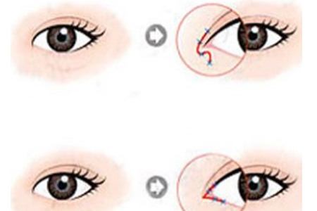 做开眼角整形手术会不会留下后遗症