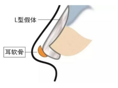 做膨体隆鼻整形手术后多久才能化妆