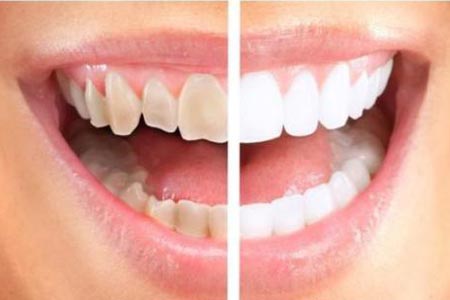 怎样才能让牙齿快速变白