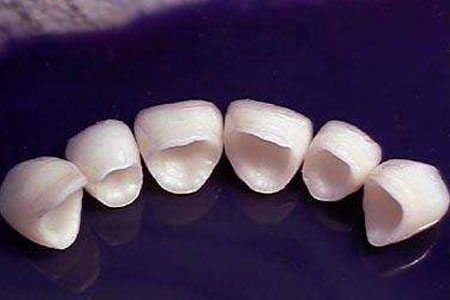 烤瓷牙和美容冠修复牙齿有什么不同