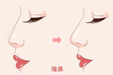韩式隆鼻整形术后怎么护理鼻子