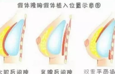 隆胸需要多少钱呢