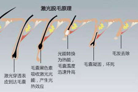 什么方法脱毛比较好啊