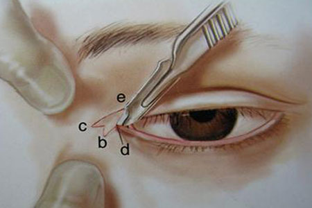 开眼角术后护理要注意什么