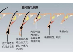 激光脱腋毛对身体有没有伤害