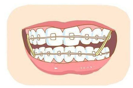 牙齿矫正有哪些方法，哪种好