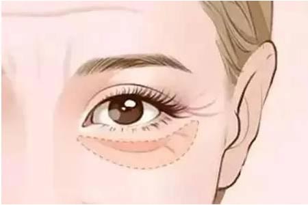 什么方法可以有效的去除浮肿的眼袋