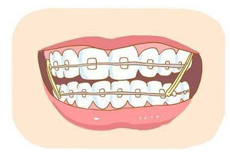 牙齿矫正的方法有哪些，哪种矫正好