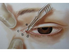 开眼角整形手术会不会很疼啊