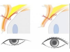 上眼睑下垂了怎么办，能矫正吗