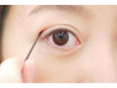 韩式双眼皮整形术后能保持多久