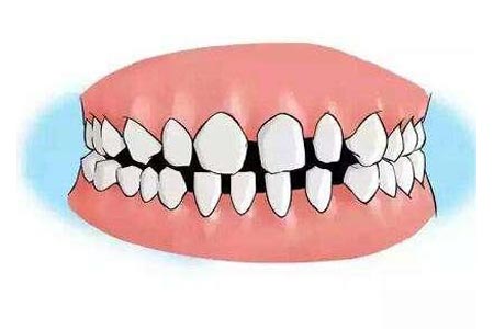 牙齿畸形的危害有哪些啊