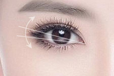 双眼皮整形手术有哪些优势
