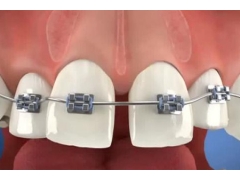 快速矫正牙齿的方法有哪些