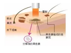 脸上长了很多斑什么方法