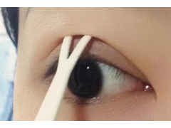 做韩式双眼皮整形手术会不会容易留疤