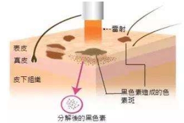 激光祛斑之前使用祛斑产品会有影响吗？