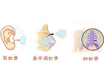 肋骨、鼻软骨、耳软骨隆鼻材料哪种好