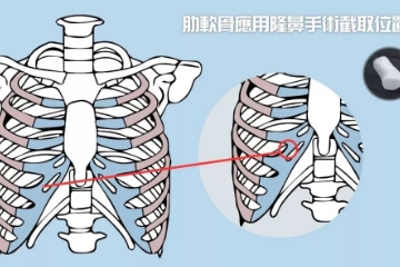 肋骨、鼻软骨、耳软骨隆鼻材料哪种好