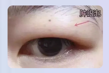 肿泡眼做出来的双眼皮是什么样呢？