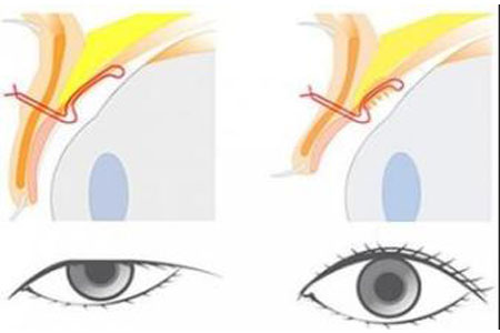 做眼皮下垂矫正手术多少钱