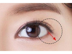 开眼角手术后会出现肿胀情况吗