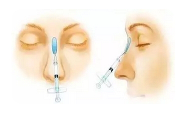 玻尿酸注射隆鼻会让鼻子变宽？