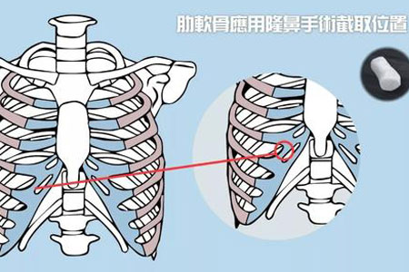 在上海做肋软骨隆鼻大概多少钱