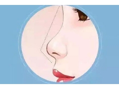 上海做假体鼻子需要多少钱,术后注意什么