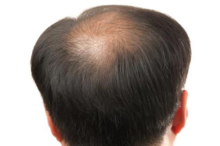 头发种植手术一般需要多少钱