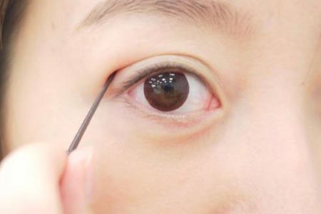 埋线双眼皮术后效果能维持几年时间