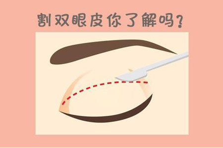 上海做双眼皮手术要多少钱，贵不贵