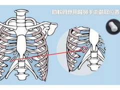 上海做自体肋软骨隆鼻手术费用是多少