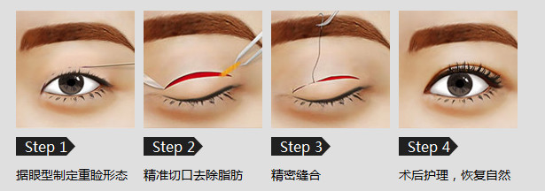 全切双眼皮的手术过程