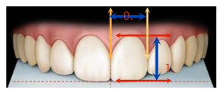 中切牙正常长宽比为75－80％
