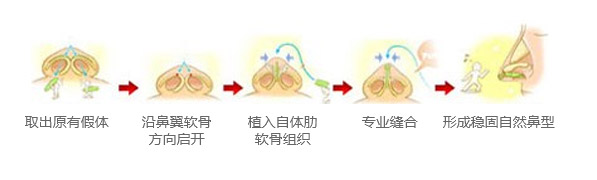 自体肋软骨全鼻修复手术示意图