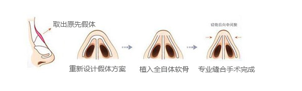 假体隆鼻修复示意图