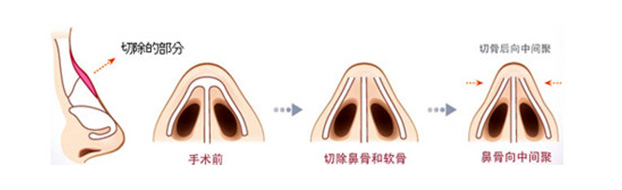 宽鼻梁矫正术手术过程