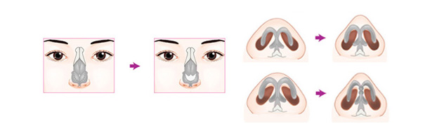 鼻头缩小术手术过程