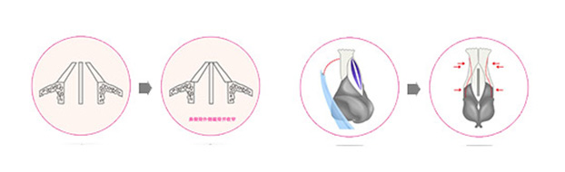 鼻背骨缩窄术手术过程